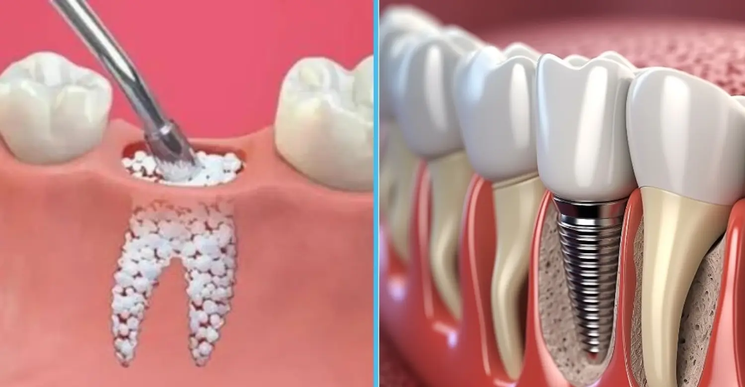 bone graft turkey implants 2